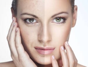 Fotorejuvenecimiento